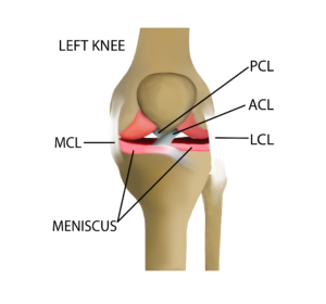 Illustration of a torn meniscus