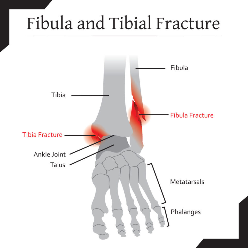Can I Run With A Stress Fracture In The Heel Bone?